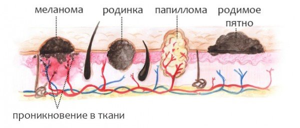 День меланоми – лідера серед онкозахворювань, відзначається в Кам’янському
