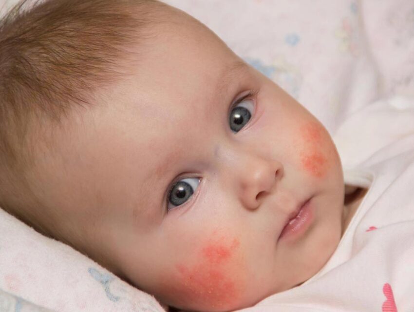 Про загрозу та лікування дитячої алергії в Кам’янському