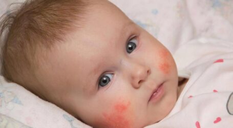 Про загрозу та лікування дитячої алергії в Кам’янському